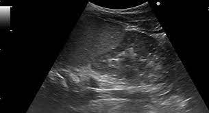 Experts believe the population of domesticated bactrian camels is around 2 million. Renal Dromedary Hump Radiology Case Radiopaedia Org