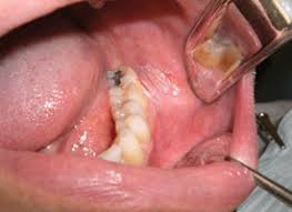 Oral and maxillofacial laser surgery. Oral Soft Tissue Biopsy An Overview Jcda