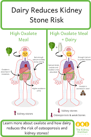 Pin On Kidney Stone Nutrition Info