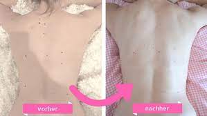 Das ist etwa der fall, wenn der. Muttermale Lasern Ich Habe Es Getan Maikikii Der Lifestyle Blog