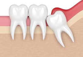Warm salt water rinse : Pericoronitis Pain Wisdom Tooth Infection Treatment Symptoms