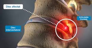 A cervical herniated disc is a common cause of pain that radiates from the neck into the arm. Hernia De Disc Simptome Cauze Tratament