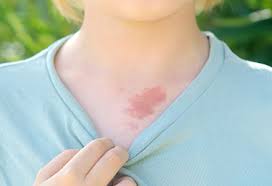 Birthmarks | Johns Hopkins Medicine