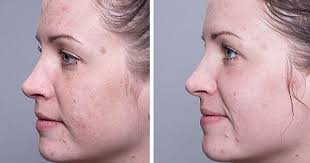 Pin On Red Light Therapy Before And After