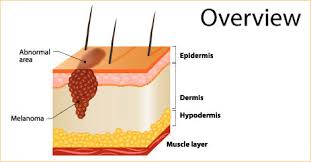 However, as with other types of cancer,. Skin Cancer Symptoms Diet Prevention Tips