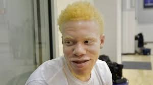Maybe you would like to learn more about one of these? Tcu S Albino Basketball Star Shares His Story Fort Worth Star Telegram