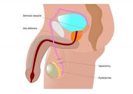 Everything You Need To Know About Male Birth Control Vasectomy Reversal Vasectomy Birth Control