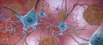 Image result for images Alzheimer's disease and related dementias