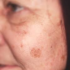 Anti aging supplements from joe rogan. Entfernung Von Pigmentflecken Estetika Nobilis