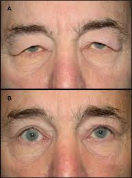 A External photograph of patient 2 preoperatively, demonstrating...