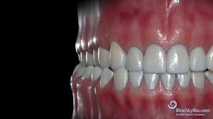 Unilateral Crossbite Functional Shift Youtube