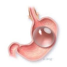 Pin On Bariatric News