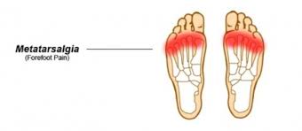 Metatarsal pain usually comes on gradually with tenderness felt when pressing in on the mtp joints under the ball of the foot. Metatarsalgia Physiopedia