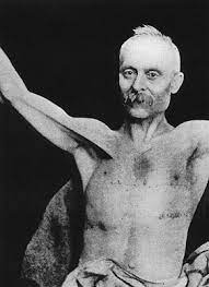 Improper Course The Big Reveal Poland Syndrome