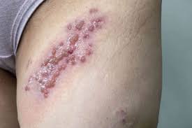 Image result for itchy skin rectum