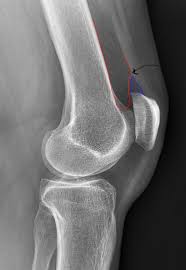 Image result for Knee XRay