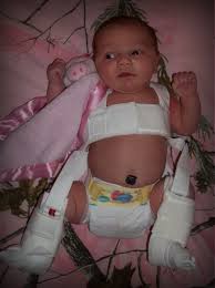 Pavlik Harness Infant Hip Dysplasia Kids And Parenting Hip Dysplasia Infant