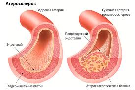 Ateroskleroz Simptomy Prichiny Sposoby Diagnostiki I Profilaktiki Medikamentoznye Metody Lateroskleroz Simptomy Prichiny Sposoby Diagnostiki I Profilaktiki Medikamentoznye Metody Lecheniya Ateroskleroza I Sredstva Narodnoj Mediciny Detskaya