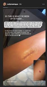 14 Celebrities Who Have Proudly Showed Off Their Scars