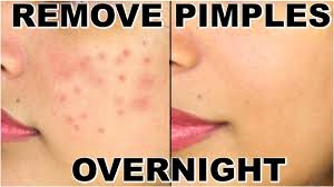 how to remove pimples overnight acne