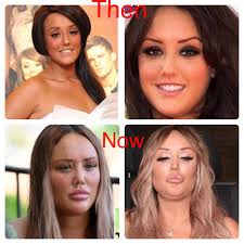 Charlotte crosby flaunts teeny tiny waist in plunging crop top despite freezing december temperatures. Charlotte Crosby And Her Brand New Face Botchedsurgeries