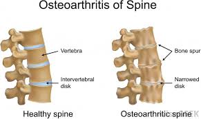 What Are Osteophytes With Pictures Osteoarthritis Bone Spurs Spinal Arthritis