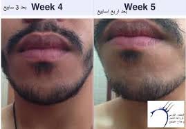 Minoxidil 5 كيفية استعمال للذقن