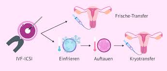 Sobald die eizelle erfolgreich befruchtet wurde, wandert die blastozyste, wie das befruchtete ei zu im medizinischen bereich wird bei der einnistung zudem von einer nidation gesprochen, weshalb. Der Kryotransfer Wie Hoch Ist Die Erfolgsrate Bei Tiefgefrorenen Embryos
