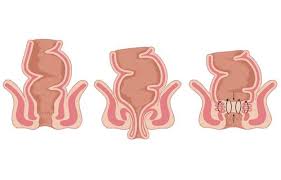 Image result for Rectal prolapse