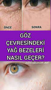 Goz Cevresi Yag Bezeleri Nasil Gecer In 2021