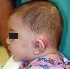 Image result for Mastoiditis