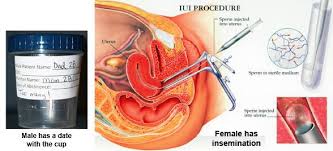 Rawatan iui ni berkesan untuk pasangan yang ada masalah unexplained fertility ataupun wanita p/s/s: Ibu Ini Kongsi Usahanya Buat Rawatan Iui Sehingga Berjaya Hamil Selepas 3 Tahun Berkahwin Pa Ma