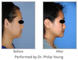 Liposuction Contouring Of The Neck 20 S Something Female Facial Plastic Facial Plastic Surgery Plastic Surgeon