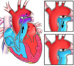 The murmur, along with symptoms of heart failure in a premature infant, most often lead to the diagnosis of patent ductus arteriosus. Patent Ductus Arteriosus Pda What Is It Symptoms Treatments