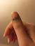 When To Drain A Smashed Finger