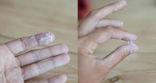 You may experience spotting a few days after taking plan b®, but this is not your period. Pictures And Videos Of Cervical Mucus Ovulation Discharge Cervical Fluid Groove