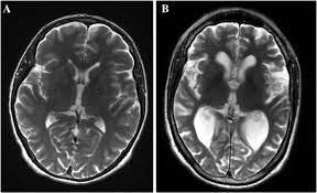 Brain Mri Axial T2 Images Shows Cerebral Atrophy In Patient With Download Scientific Diagram