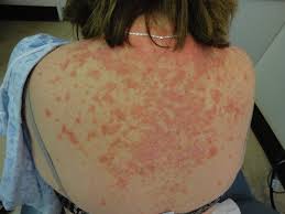 If accepted for publication, authors are requested to pay an article processing fee per article. Pityriasis Rubra Pilaris