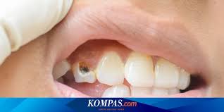 Ilmuwan Temukan Metode Baru Obati Gigi Berlubang Tanpa Penambalan Halaman All Kompas Com