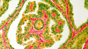 Ductal carcinoma in situ and microinvasive carcinoma. Metastatic Adenocarcinoma Types And Treatment Everyday Health