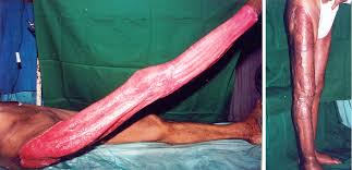 Skin Grafting On Granulating Wounds Short Notes In Plastic Surgery