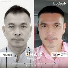 FACEBODY HAIR (หมอธีร์) แพทย์ผู้เชี่ยวชาญด้านการปลูกถ่ายเส้นผม