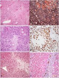 Riesige auswahl an cds, vinyl und mp3s. A Massive Hepatic Necrosis Liver Cell Dropout Residual Hepatocytes Download Scientific Diagram