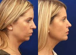 Patient 2630 Chin Augmentation Before And After Photos Chin Augmentation Chin Implant Plastic Surgery