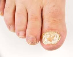 Which Is The Best Over The Counter Toenail Fungal Cream