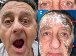 Image result for Anhidrosis