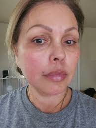 Will soolantra help with these rash