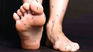 Image result for Paresthesia