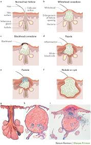 Acne Vulgaris Nature Reviews Disease Primers
