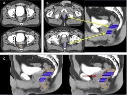 Winship experts are available to provide a second opinion. Estro Acrop Consensus Guideline On Ct And Mri Based Target Volume Delineation For Primary Radiation Therapy Of Localized Prostate Cancer Radiotherapy And Oncology